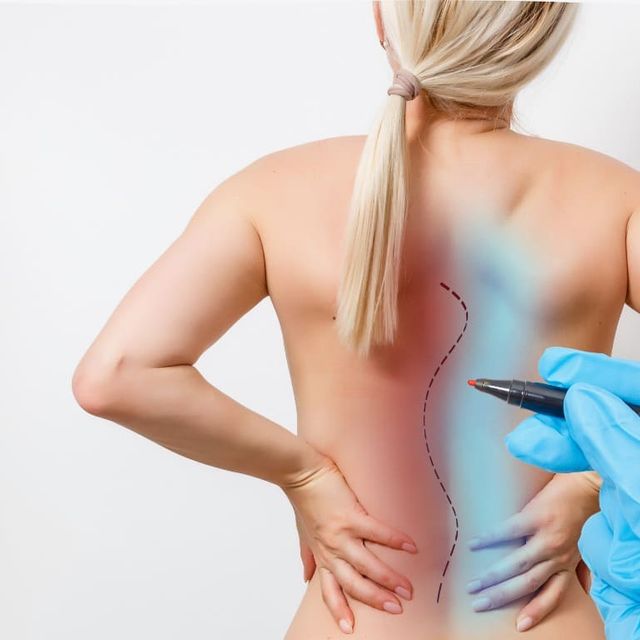 espalda torcida escoliosis